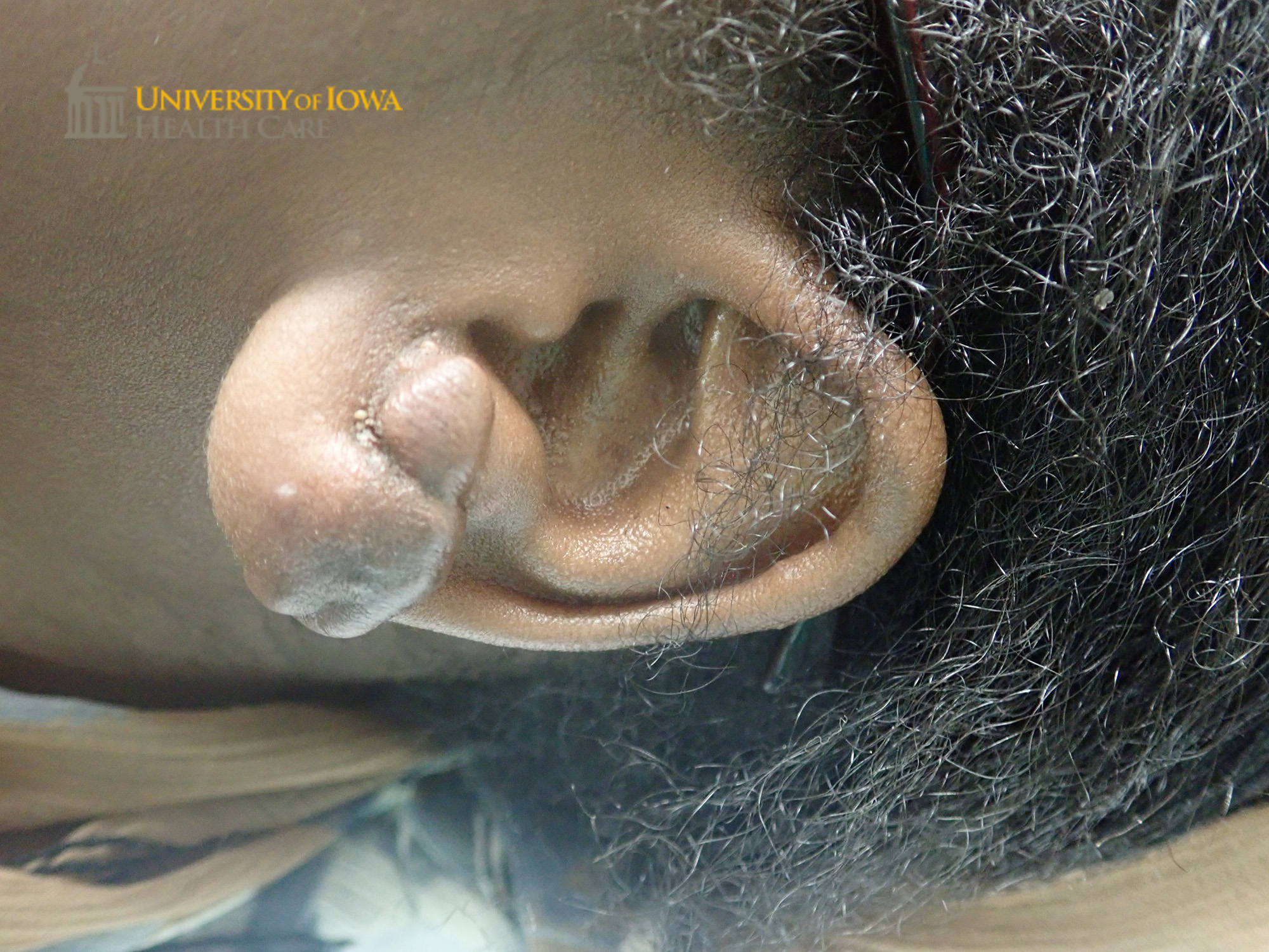 Keloidal nodules on either side of ear from piercing. (click images for higher resolution).